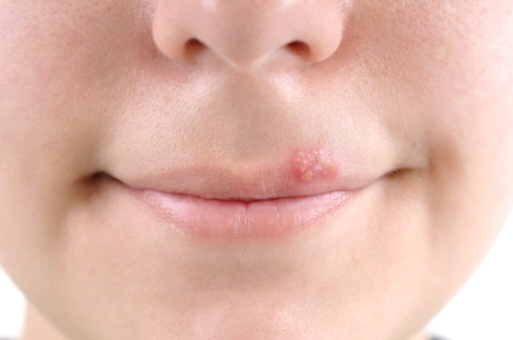 o que causa a herpes labial vitergan
